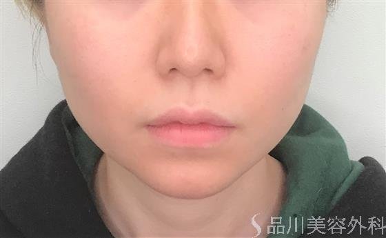 症例NO.55162のBEFORE写真