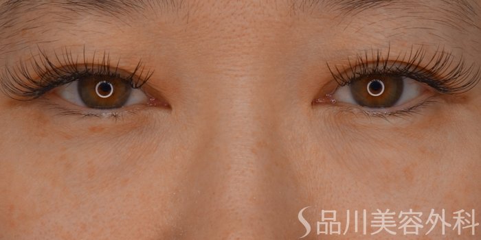 症例NO.69678のBEFORE写真