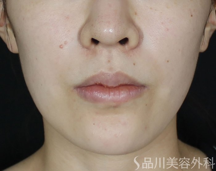 症例NO.70686のBEFORE写真