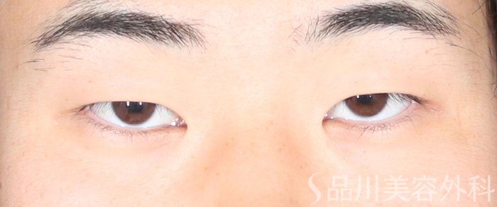 症例NO.73084のBEFORE写真