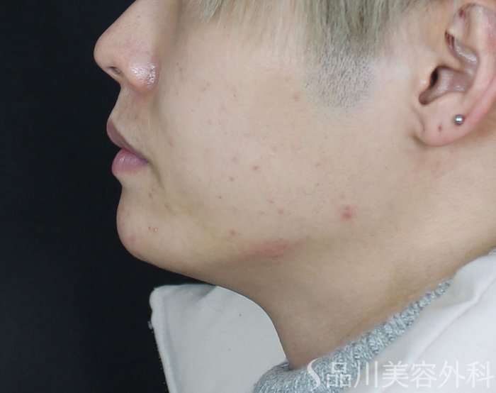 症例NO.71958のAFTER写真