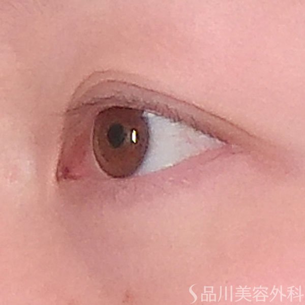 症例NO.69589のBEFORE写真