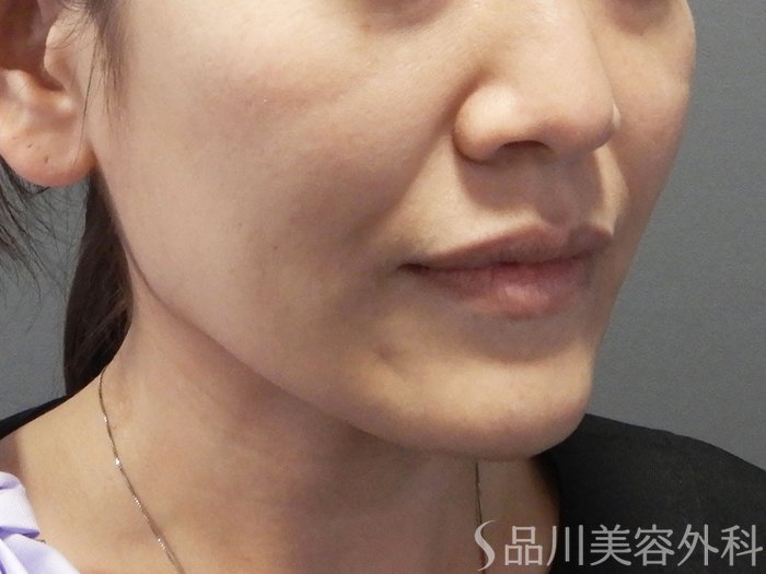 症例NO.73145のBEFORE写真