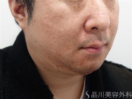 症例NO.46375のAFTER写真