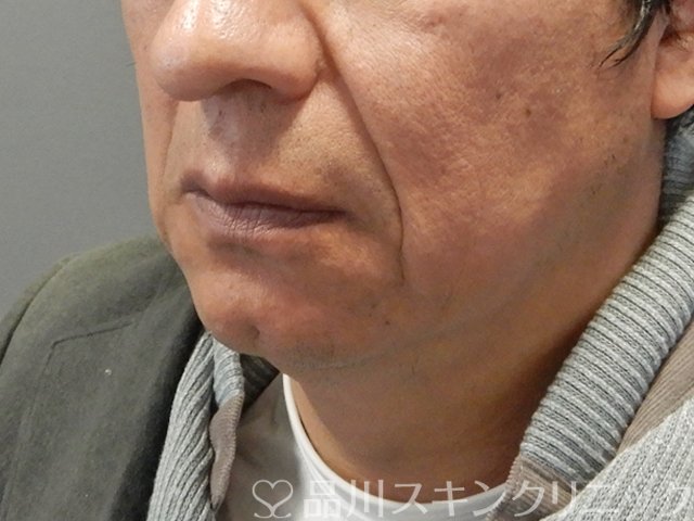 症例NO.75134のBEFORE写真