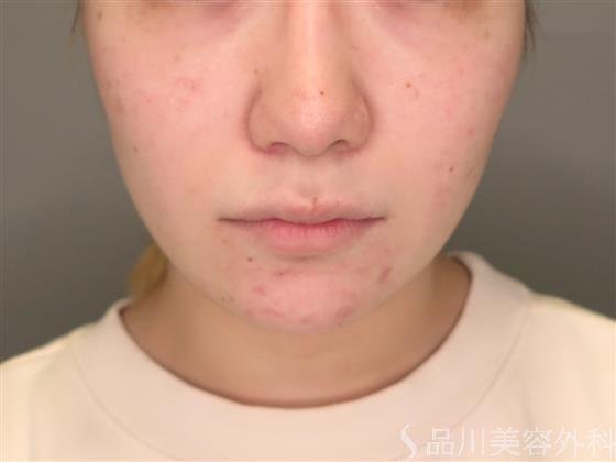 症例NO.49223のBEFORE写真