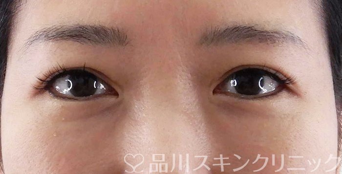 症例NO.62183のBEFORE写真