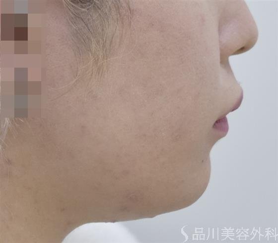 症例NO.53434のBEFORE写真