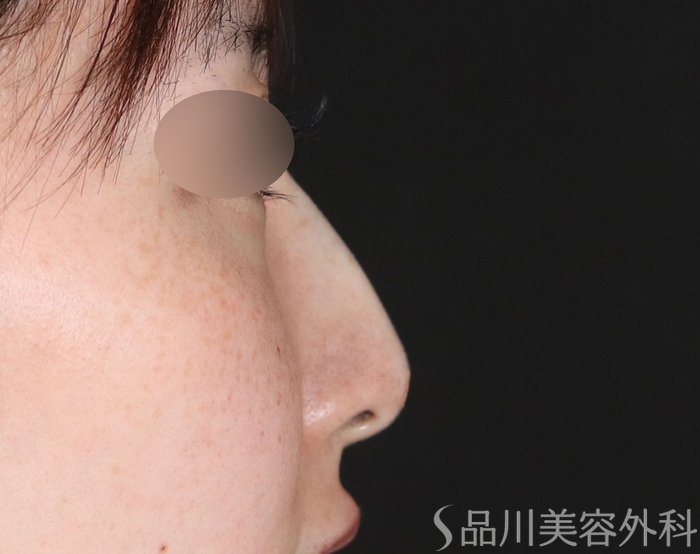 症例NO.74091のAFTER写真