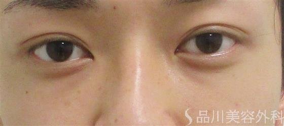 症例NO.55814のAFTER写真