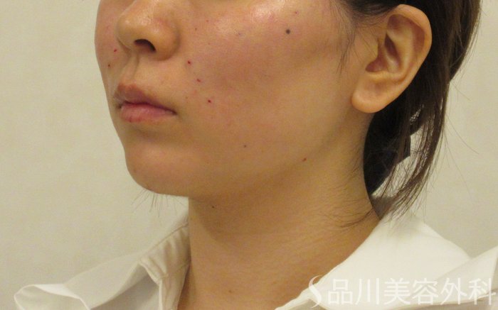 症例NO.72461のAFTER写真