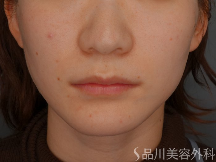 症例NO.73635のAFTER写真