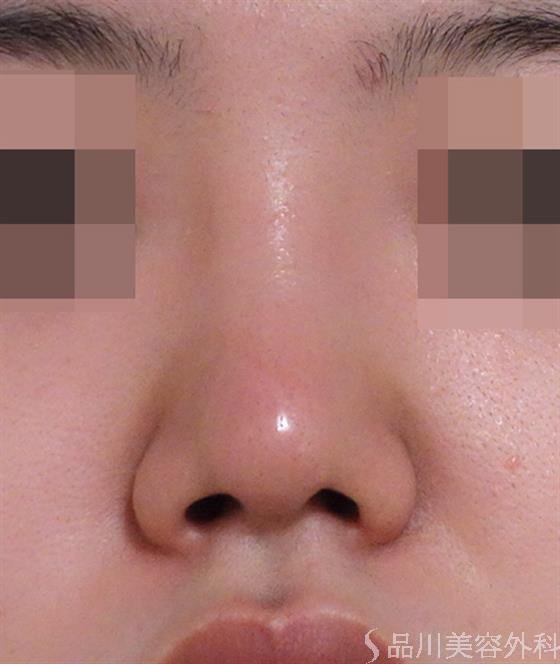 症例NO.40272のAFTER写真