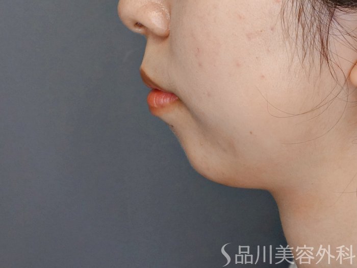 症例NO.70027のBEFORE写真