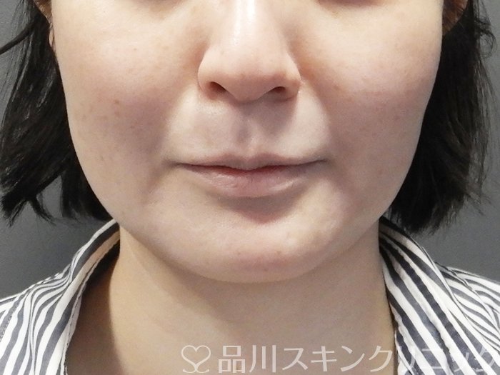 症例NO.73382のAFTER写真