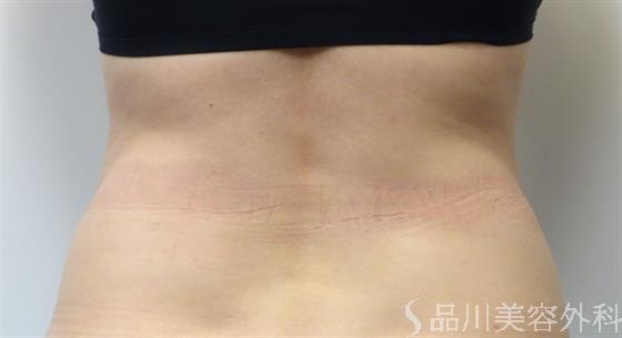 症例NO.43570のAFTER写真