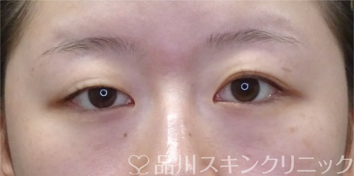 症例NO.69790のBEFORE写真