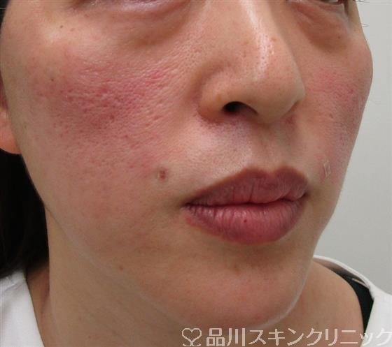 症例NO.30719のAFTER写真