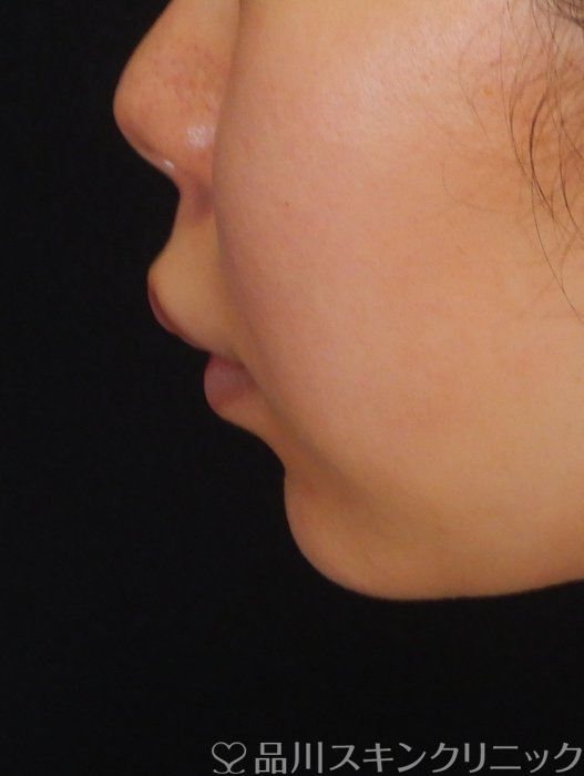 症例NO.66312のBEFORE写真