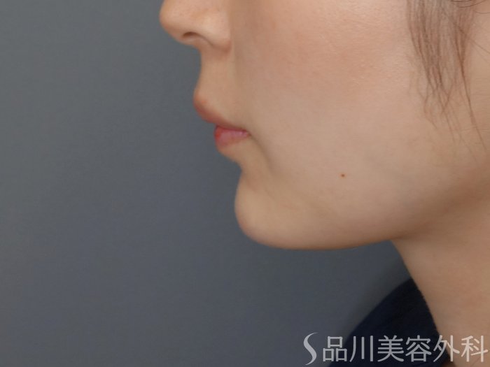 症例NO.70164のAFTER写真