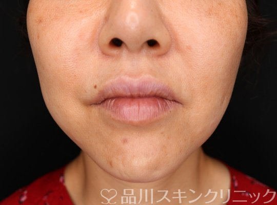 症例NO.73708のBEFORE写真