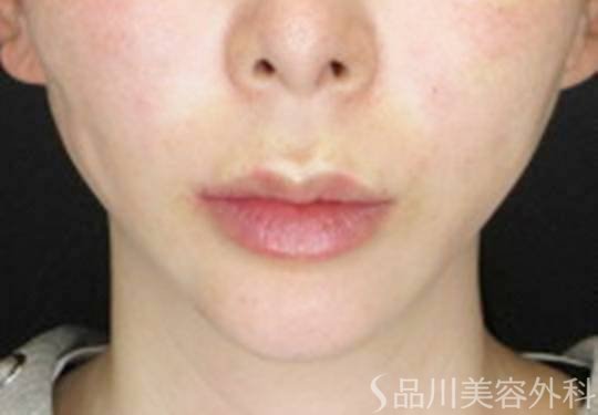 症例NO.72468のAFTER写真