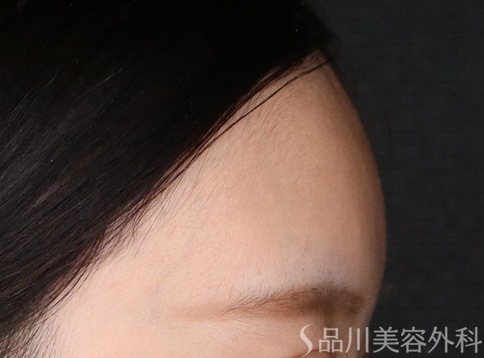 症例NO.71643のAFTER写真