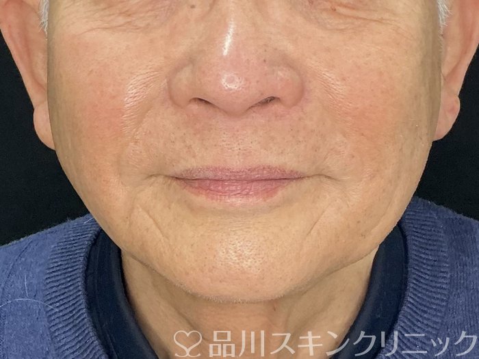 症例NO.73042のAFTER写真