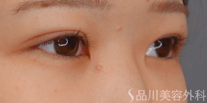 症例NO.72344のAFTER写真