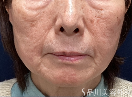 症例NO.73425のAFTER写真