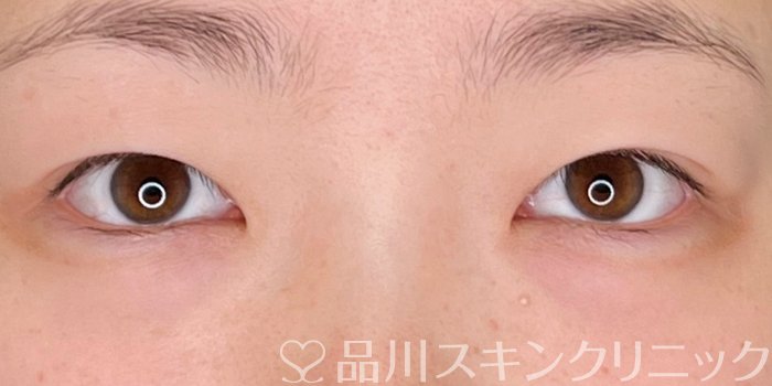 症例NO.69912のBEFORE写真