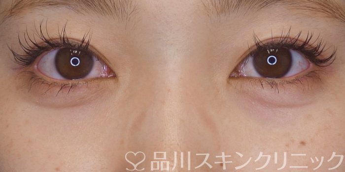 症例NO.72532のAFTER写真