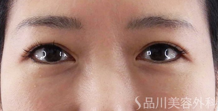 症例NO.62183のBEFORE写真