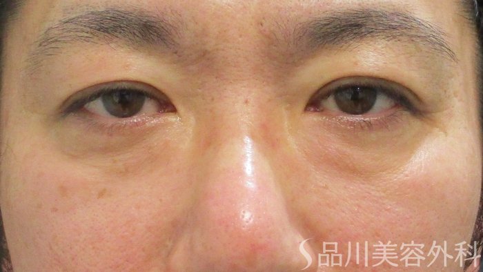 症例NO.70668のBEFORE写真