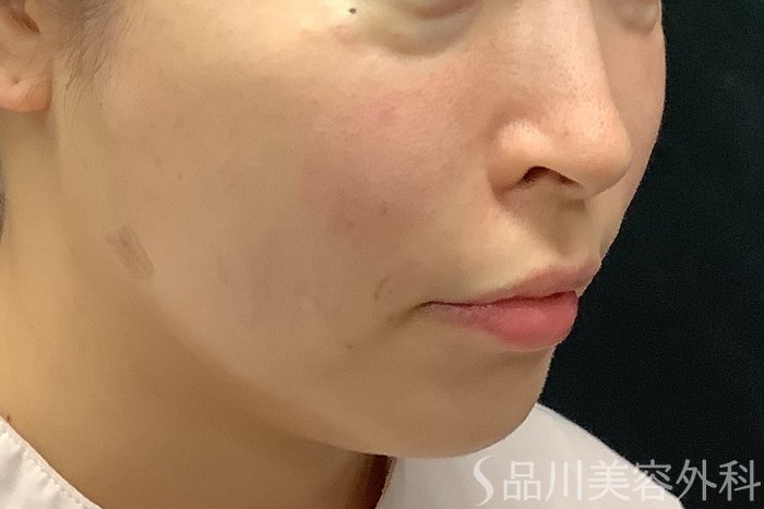 症例NO.71243のAFTER写真