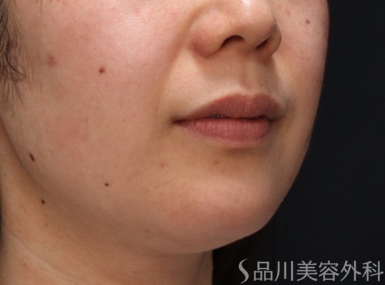 症例NO.73864のBEFORE写真