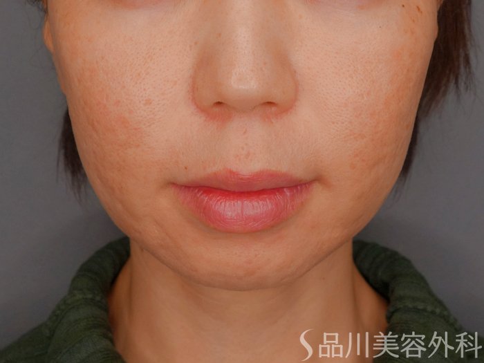 症例NO.73246のBEFORE写真