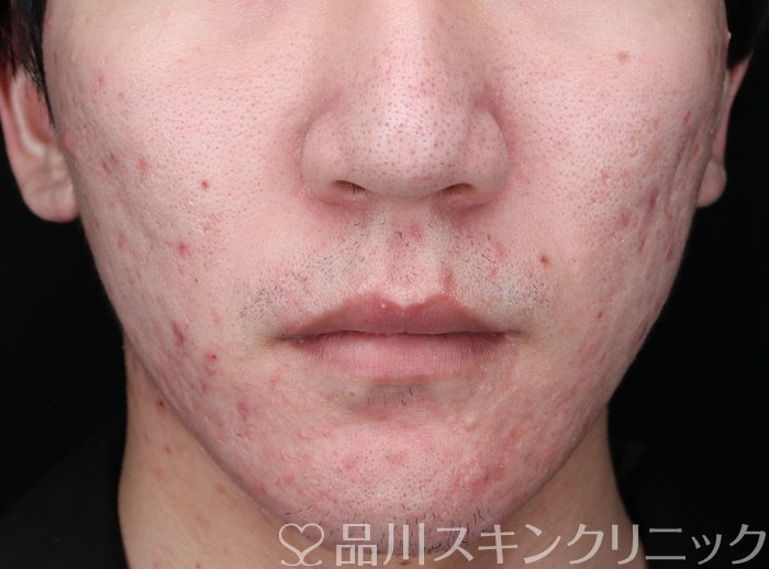 症例NO.74741のBEFORE写真