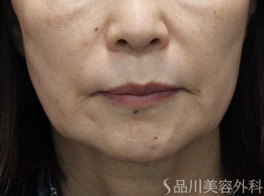 症例NO.75105のBEFORE写真