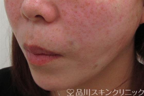 症例NO.35160のAFTER写真