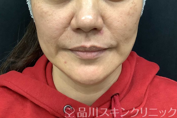 症例NO.69667のBEFORE写真