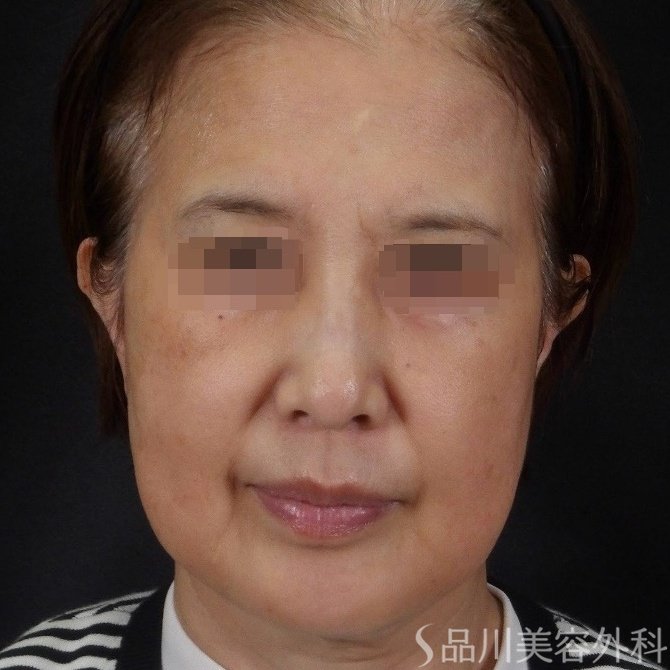 症例NO.70111のBEFORE写真