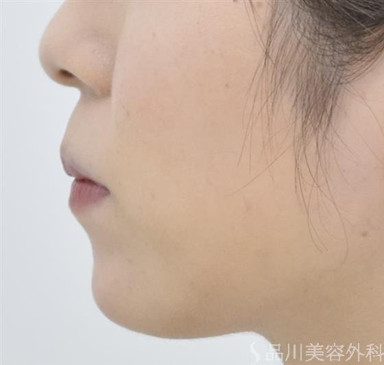 症例NO.42879のAFTER写真