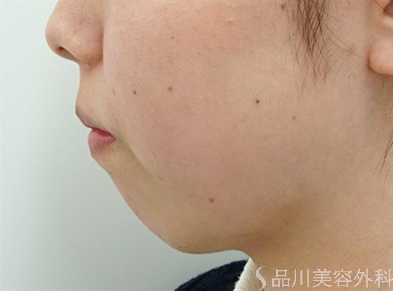 症例NO.47728のBEFORE写真