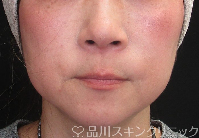 症例NO.72929のBEFORE写真