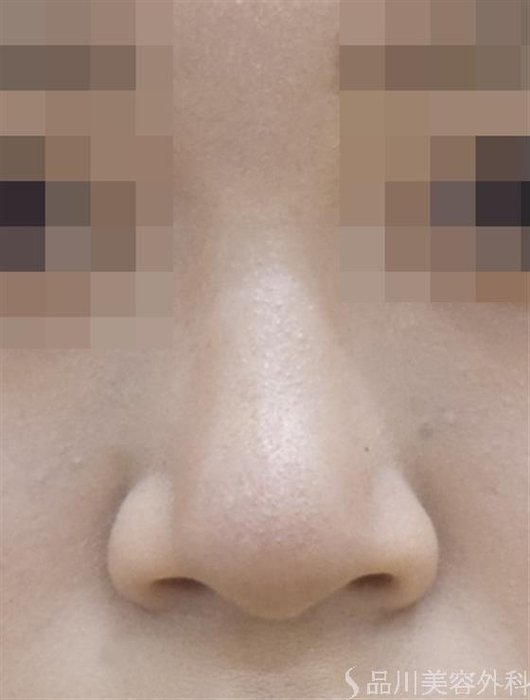 症例NO.52914のAFTER写真