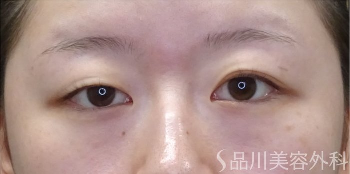 症例NO.69790のBEFORE写真