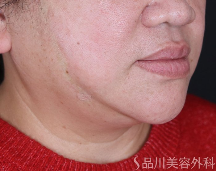 症例NO.73470のAFTER写真