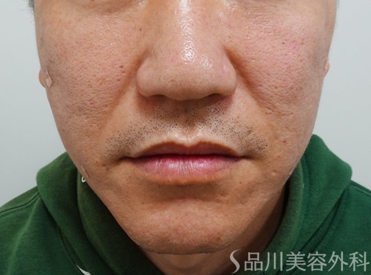 症例NO.73521のAFTER写真