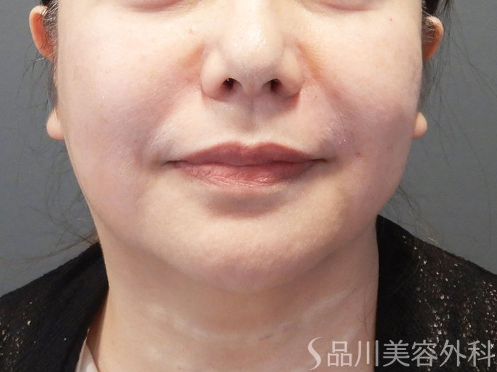 症例NO.74128のAFTER写真